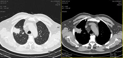 Discussion of tumor mutation burden as an indicator to predict efficacy of immune checkpoint inhibitors: A case report